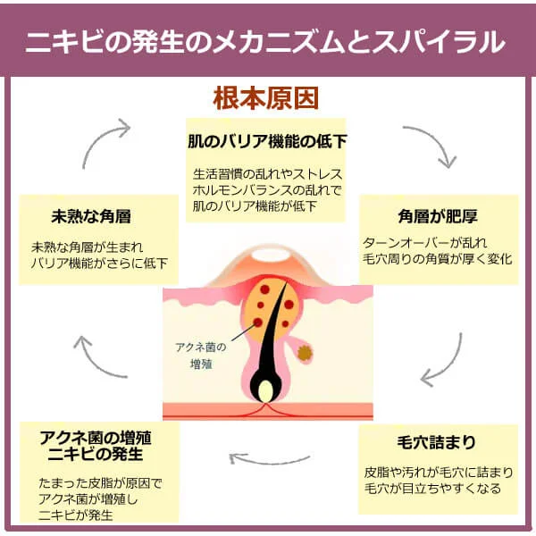 ニキビができる原因