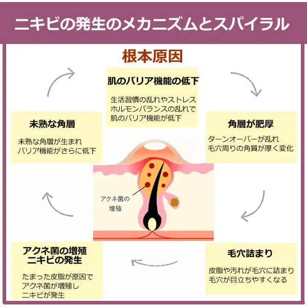 ニキビができる原因