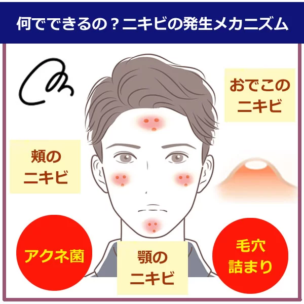 繰り返すニキビに！対策とスキンケア
