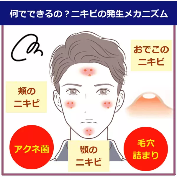 繰り返すニキビに！対策とスキンケア